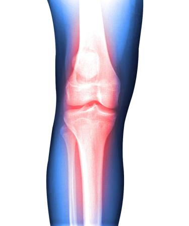 Soles Hinged Knee ROM Orthosis (SLS311S) | International Shipping | Comfortable & Adjustable Knee Support - Buy Online on GoSupps.com