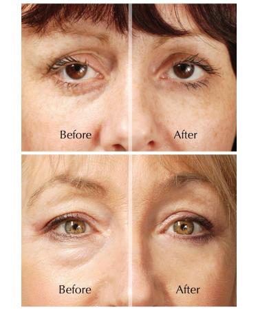 ROX Eye Lifting - TV Rox Anti Eye Wrinkle Booster | International Shipping Available - Buy Online on GoSupps.com