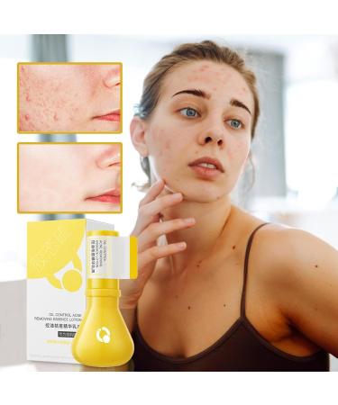 Bump Remover Face Lotion 30ml Natural Face Skin Soothing Bump Lotion Women Girls Day And Night Use Gentle Skin Care Lotion For Sister Mom - Buy Online on GoSupps.com