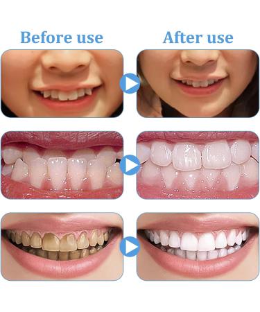 Inbolm 4pcs Teeth Whitening & Grinding Mouth Guards - Retainers for Protecting, Tray for Whitening, Grinding - Buy Online on GoSupps.com