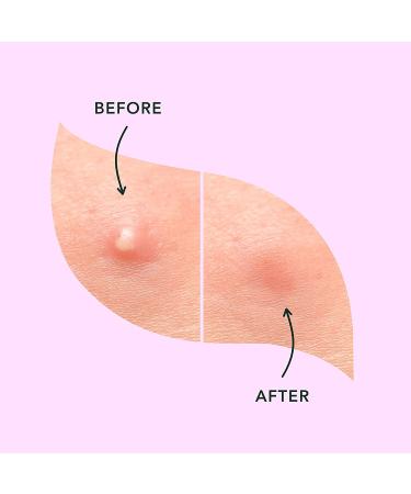 Rael Miracle Overnight Spot Cover - Thicker & Extra Adhesion  Hydrocolloid Acne Pimple Patches  Blemish Spot Stickers for Face  Absorbing Cover  3 Sizes (52 Count) 52 Count (Pack of 1) 52.0 - Buy Online on GoSupps.com