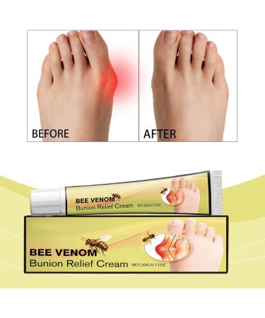 Bee Venom Bunion Relief Cream Bunion Relief Rub Bunion Relief Balm Bunion Cream Bunion Gout Cream Toe and Knee Joint Cream Healing Cream for Aching Bunions & Dry Cracked Skin(1pcs) - Buy Online on GoSupps.com