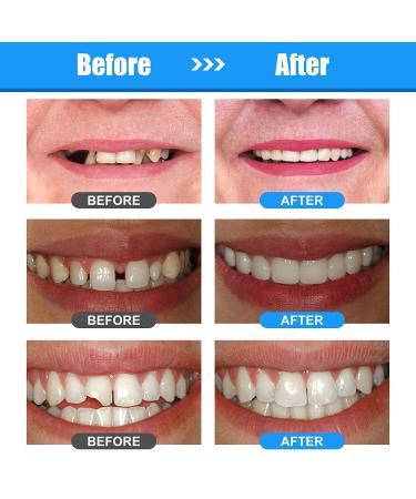Temporary Tooth Repair Kit - Moldable Fake Teeth for Missing & Broken Teeth - Buy Online on GoSupps.com