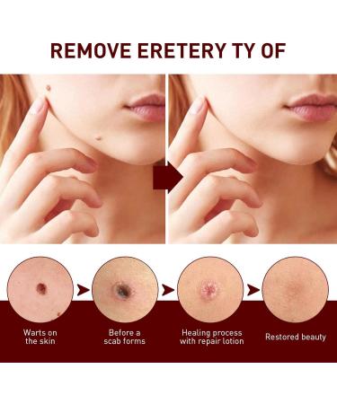 Skin Tag Removal Skin Tag Remover Mole Remover Pen Skin Tag Remover Pen Natural Non-Irritating Skin Tag Remover for All Skin Types - Buy Online on GoSupps.com