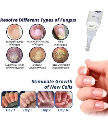 7 Days Nail Recovery Growth Essence Pen - Strengthening Serum for Thin Nails | Fast Nail Repair Solution - 1 PC - Buy Online on GoSupps.com