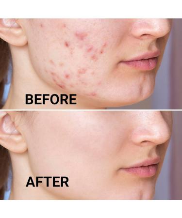 DERMATOUCH Acnecare Moisturizer with Salicylic Acid & Oatmeal - Buy Online on GoSupps.com