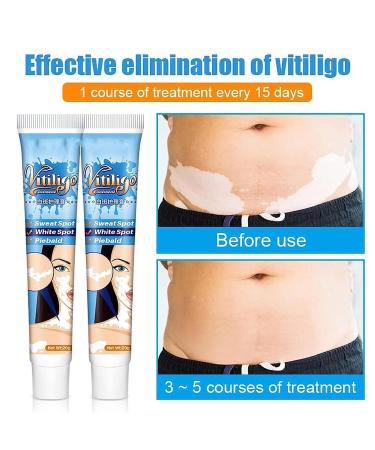 Vitiligo Therapy Cream: Soothing Ointment to Reduce White Spots & Improve Skin Pigmentation - Buy Online on GoSupps.com