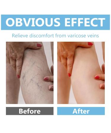 ITECFREELY Varicose Veins Cream Improve Blood Circulation Varicose Veins Care Fast Soothe Cream for Legs Blue - Buy Online on GoSupps.com