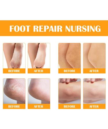 Foot Callus Removal Spray Foot Peel Spray Instant Foot Peeling Spray Orange Oil Foot Callus Remover Spray for Cracked Rough Heels Calluses & Dry Toe Skin Elbow Leg Shoulder Back Knee Use - Buy Online on GoSupps.com