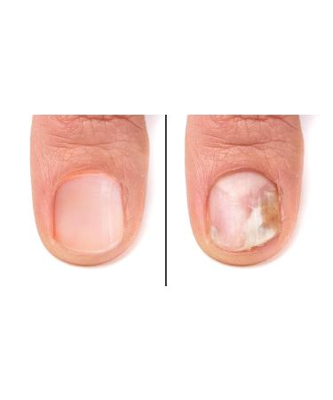 Barielle Fungus Rx 1oz: Powerful Antifungal Treatment - Buy Online on GoSupps.com