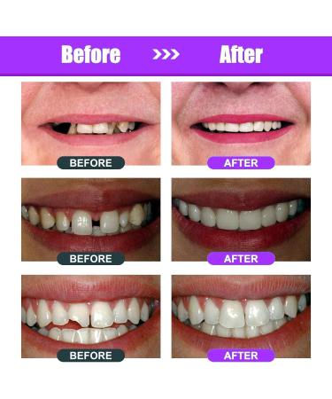 Tooth Repair Kit - Moldable Dental Filling for Missing & Broken Teeth | DIY Home Kit to Regain Your Confident Smile - Buy Online on GoSupps.com