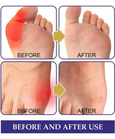 Strongjoints Anti Bunion Patch - Pain Relief & Protection (3 Boxes/15 Pcs) - Buy Online on GoSupps.com