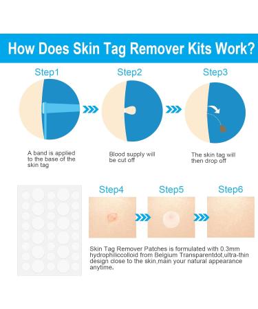 Painless 2-in-1 Skin Tag Removal Kit for Micro to Large Skin Tags (1-9mm) - Safe & Easy DIY Tool for Home Use - Buy Online on GoSupps.com