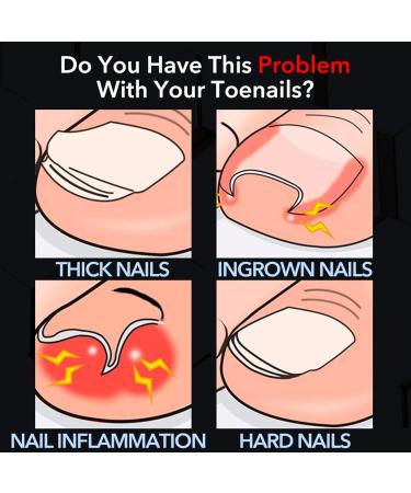 Toenail Clippers for Thick Ingrown Toenails Stainless Steel Nail Cutter Professional Manicure Accessories Tools (Color : Red) - Buy Online on GoSupps.com