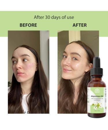 Relaxcation Abyssinian Oil | 100% Pure Cold Pressed Crambe Abyssinica Seed Oil | Lightweight Natural Extract for Skin Hair Scalp & Nails | Fast Absorbing Non-Greasy Amber Glass Bottle (4 oz) 4 Fl Oz (Pack of 1) - Buy Online on GoSupps.com
