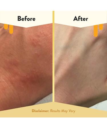 ECZEMA HONEY Oatmeal & Lavender Soap & Oatmeal Body Lotion - Bundle for Sensitive & Dry Skin - Cruelty Free - Buy Online on GoSupps.com