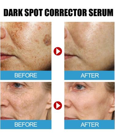Dark Spot Corrector cream Serum Sheep Placenta Intensive Facial Serum Collagen Serum Sheep Placenta Collagen Serum Blemishskin Corrector Serum Moisturizing Essence - Buy Online on GoSupps.com