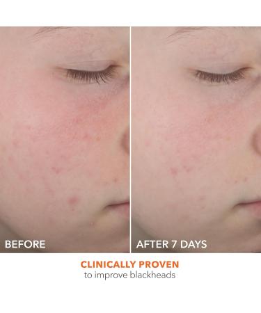 Dr. Dennis Gross Alpha Beta On The Spot Eliminator - 2% Salicylic Acid Spot Treatment for Blemish Control 1 Fl Oz - Buy Internationally - Buy Online on GoSupps.com