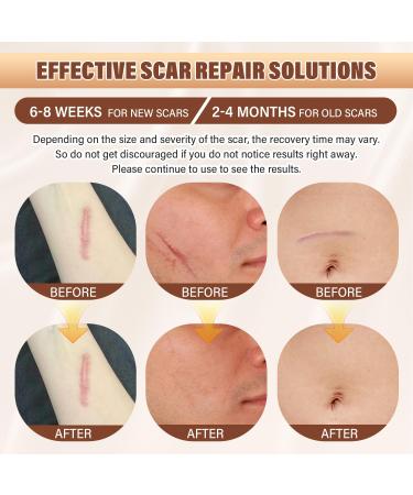 Buy Silicone Scar Sheets & Tape for Effective Scar Removal Surgical C-Section Tummy Tuck Keloid Treatment (1.6 x 59 Roll - Buy Online on GoSupps.com