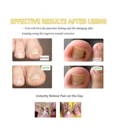 Ingrown Toenail Treatment Kit - Stainless Steel Corrector for Curved Toenails | Includes 12 Braces - Buy Online on GoSupps.com