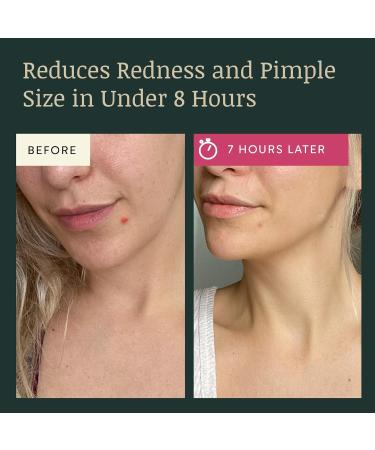 72 Hydrocolloid Pimple Patches for Face - Gentle Acne Treatment Stickers for Blemish Cover - Invisible Dots for Spots - Long Lasting Skincare Solution - Buy Online on GoSupps.com