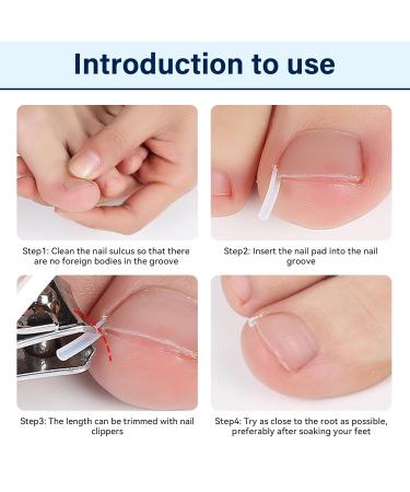 152-Piece Ingrown Toenail Tool Set & Correction Patch for Ingrown Toenails - International Shipping Available - Buy Online on GoSupps.com