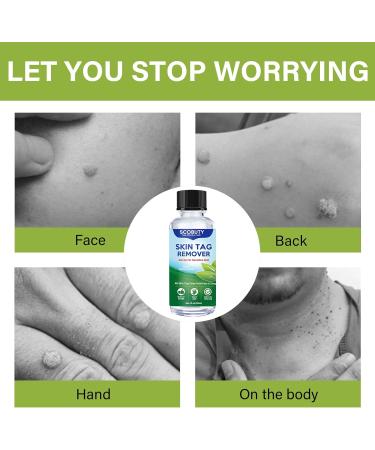 SCOBUTY Skin Tag Removal Kit Verruca Treatment Wart and Mole Remover for Hands Face - Buy Online on GoSupps.com