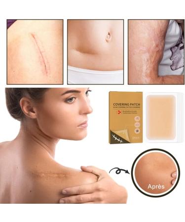 Autocollant Cicatrice Invisible Patch Peau Imperm able et Respirant pour Dissimulation Tatouage Correcteur Opaque Ultra Fin et Doux Ruban Camouflage Cicatrices et Marques Cutan es - Buy Online on GoSupps.com
