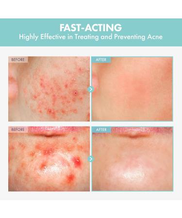 Heartleaf Tea Tree Tok Acne Treatment Toner Serum - Soothing Korean Skincare for Pore Control & Excess Sebum (50ml - Buy Online on GoSupps.com