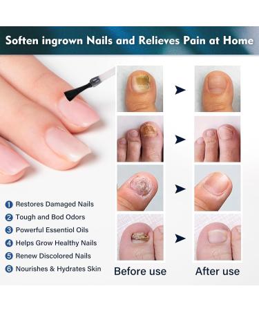 Boxmom Nail Fungus Treatment for Toenail Fungal Nail Treatment Extra Strong Toenail Fungus Treatment Nail Repair - Blue - 1.01 Fl Oz - Buy Online on GoSupps.com
