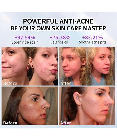 RF Radio Skin Tightening Machine w/ Red LED Therapy - Anti-Aging & Dark Circle Reduction for Face, Neck, Belly & Thighs - Buy Online on GoSupps.com