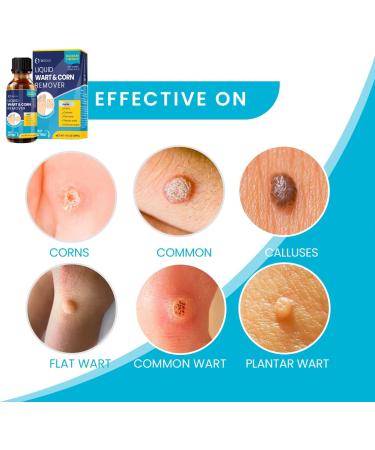 Salicylic Wart Removal Freeze Away - Maximum Strength Fast-Acting Verrugas Treatment for Men & Women | 15ml for Plantar Warts Genital Warts Corns Moles & Calluses - International Shipping Available - Buy Online on GoSupps.com