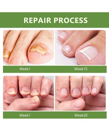 Toenail Care with Nail File Nourishing and Soothing for Nails Promotes the Regrowth of Healthy Nails 30ml - Buy Online on GoSupps.com