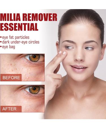 KOAHDE Milia Removal Face Serums Milia Spot Treatment Milia Treatment Spot Remover for Face Speedy Milia Remover Milia Spot Ruduce Face Serums Dark Spot Remover Face Serum Milia Removal Spot Care - Buy Online on GoSupps.com