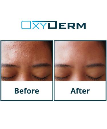Acne Clearing Treatment Pads - Salicylic, Glycolic & Lactic Acid Formula for Cystic Breakouts and Oily Skin - Buy Online on GoSupps.com