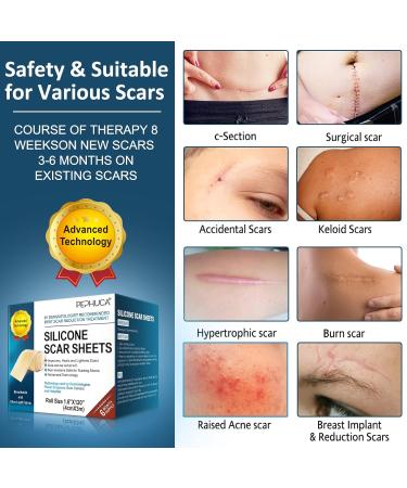 Medical Grade Silicone Scar Sheets - Reusable Gel Tape for Effective Scar Removal - 120x1.6 Roll, Skin Color - Buy Online on GoSupps.com