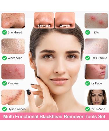 Fangze Blackhead Remover Tool Kit - 6 Pcs Pimple Popper Tool Kit Set Professional Blackhead Extractor for Face Nose (Silver) - Buy Online on GoSupps.com