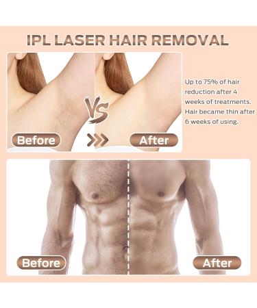 IPL Hair Removal Device - 999 900 Light Impulses for Men & Women | Permanent & Painless Laser Hair Removal for Face Body Armpits & Legs - Buy Online on GoSupps.com
