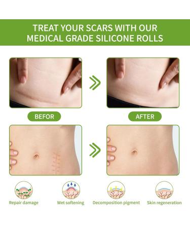 Premium Silicone Scar Tape - Medical-Grade Pain-Free Solution for All Scars - Easy Application & Removal - Buy Online on GoSupps.com