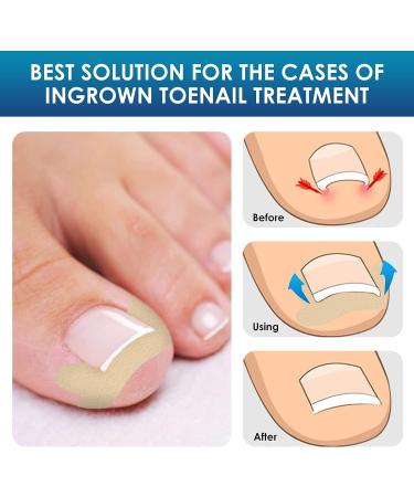 Ingrown Toenail Treatment Kit - 50Pcs Corrector Patch, File, and Lifter - Professional Pain-Free Pedicure - Buy Online on GoSupps.com