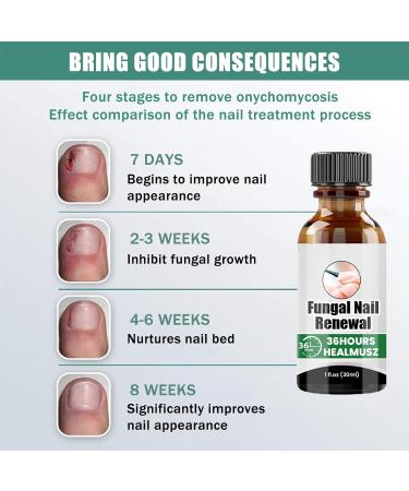 Extra Strong Fungal Nail Serum for Toe and Finger - Repair, Renew, Strengthen Nails - Buy Online on GoSupps.com