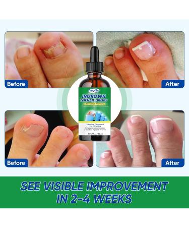Ingrown Toenail Treatment Drops - Fast Acting Pain Relief & Softener 30ml - Buy Online on GoSupps.com