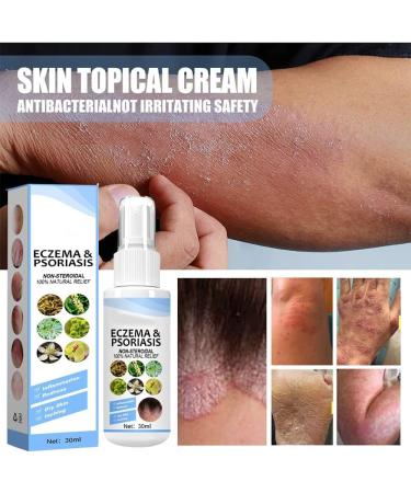 CCZGCP Meellop Herbal Psoriasis Relief Spray 30ml - Natural Ingredients for All Skin (4pcs) - Buy Online on GoSupps.com