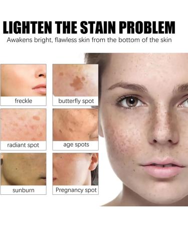 Age Spot Remover for Face Dark Spot Remover for Face & Body Spot Cream Dark Spot Corrector Freckle Remover Cream Hyperpigmentation Treatment Formulated with Nicotinamide Vitamin E Glycerol - Buy Online on GoSupps.com