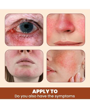 Rosacea Face Serum Anti Redness Face Serum for Women Relieve Redness & Acne Mark Dark Spot Correcting Glow Serum Anti Aging Serum for Face Hydrating Face Serum Skin Care for Women Dark Spots Remover - Buy Online on GoSupps.com