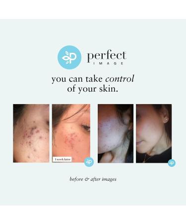 Salicylic 20% Gel Peel: Breakout & Pore Minimizer, Strength Level 2 - 15-30 Full Facial Peels - 1 fl oz - Buy Online on GoSupps.com