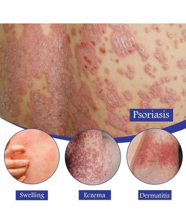EXQST 30ml Psoriasis Repair Spray - Herbal Treatment for Skin Plaque Psoriasis - Stops Burning and Itching - 3pcs - Buy Online on GoSupps.com