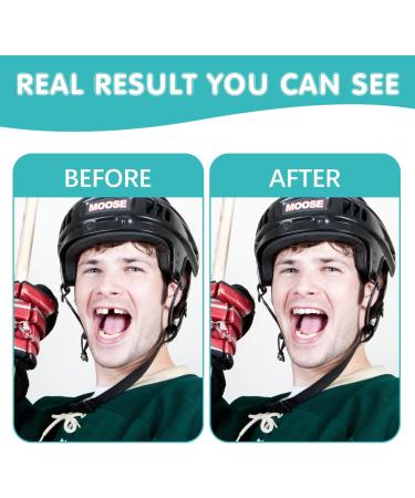 2 Pcs Fake Tooth Temporarily Fix Your Teeth Instant Smile Moldable Thermal Fitting Beads Adjust to Fit Your Teeth Replace a Missing Tooth for Teeth Whitening Kit - Buy Online on GoSupps.com