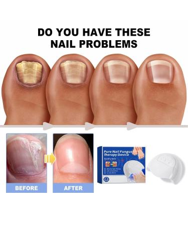 Furzero Pureail Nail Fungus Laser Therapy Device - Effective Fungus Treatment for Healthy Nails | Fast International Shipping - Buy Online on GoSupps.com
