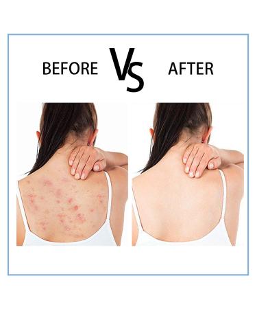 Back Acne Spray - 2% Salicylic Acid & Azelaic Acid Treatment for Body Chest & Face with Tea Tree Oil | Soothes Itching & Redness - International Shipping Available - Buy Online on GoSupps.com